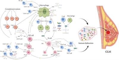 Immune regulation: a new strategy for traditional Chinese medicine-based treatment of granulomatous lobular mastitis